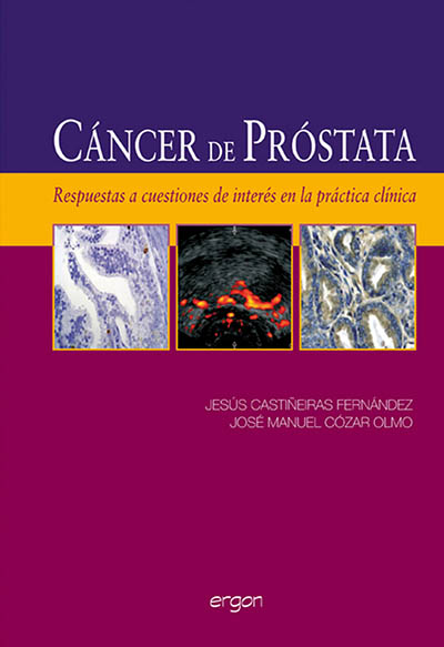 Cáncer de Próstata. Respuestas a Cuestiones de Interés en la Práctica Clínica